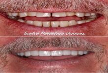Porcelain Veneers Brisbane
