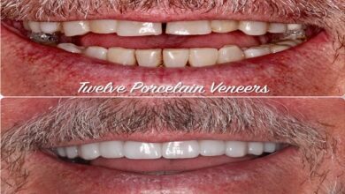Porcelain Veneers Brisbane