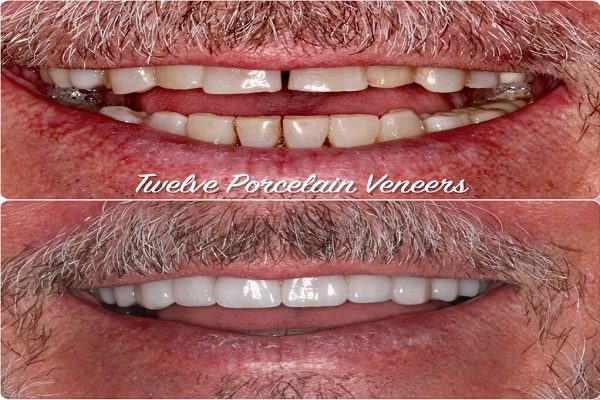 Porcelain Veneers Brisbane
